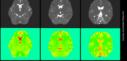 Six pictures showing a human brain scan. Three images in upper row showing black and white pictures of the brain and below these the corresponding EPT images in green with orange indicating tissue sub-types