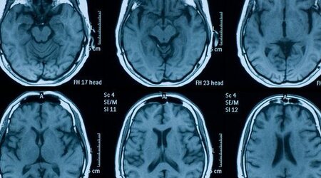 Image showing MRI scan of the brain