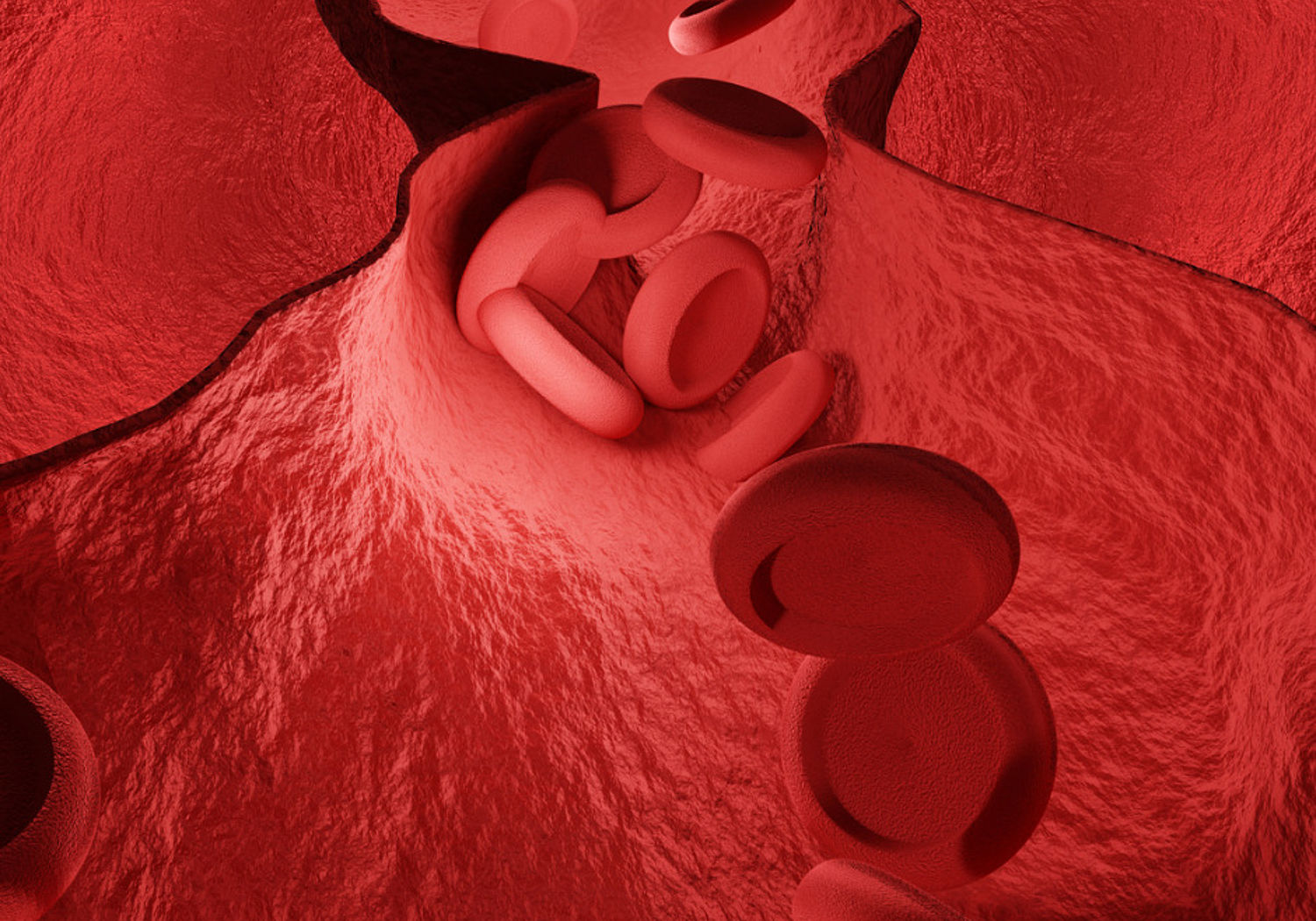 Image of red blood cells blocking an artery