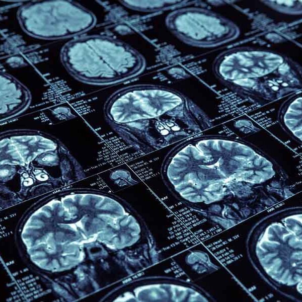 Magnetic resonance imaging brain scans