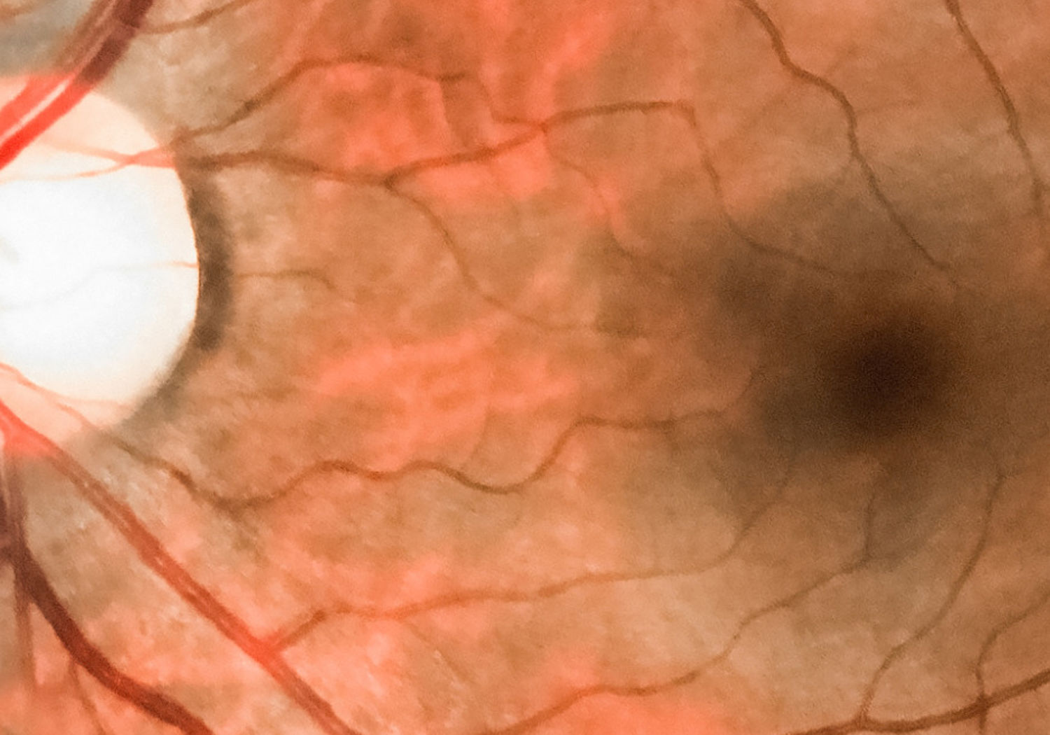 Image sho0wing a medical photo of a pathology vein occlusion