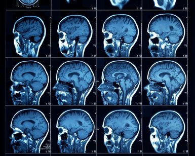 Image showing sliced section CT scan of a human head, showing the cerebral cortex through to the sinus cavities