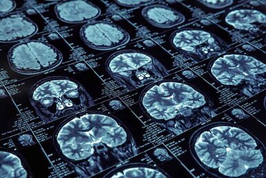 Magnetic resonance imaging brain scans