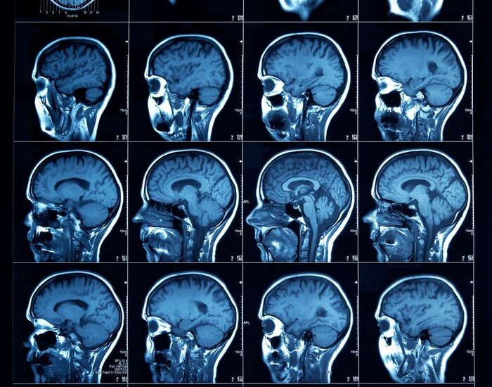 Image showing sliced section CT scan of a human head, showing the cerebral cortex through to the sinus cavities