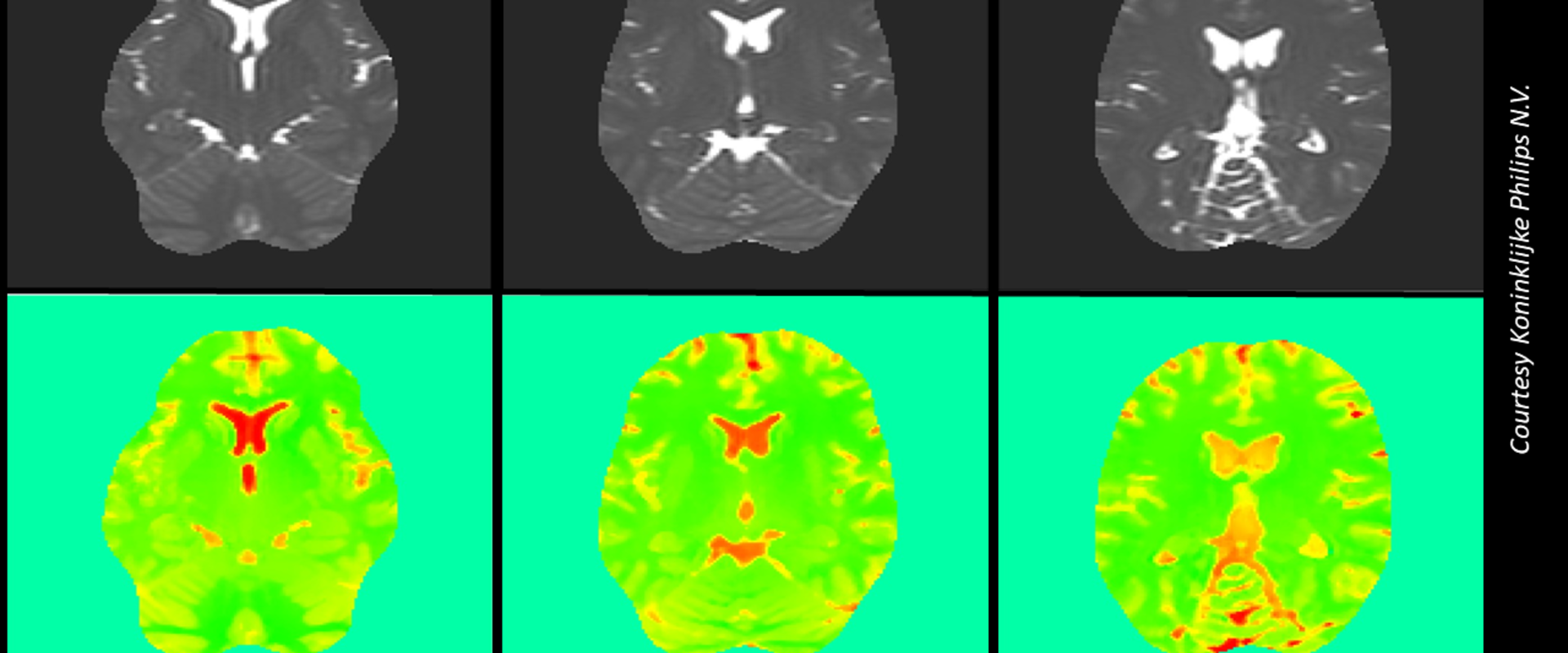 MRI of a healthy brain. Top row anatomical image. Bottom row EPT images Six pictures showing a human brain scan. Three images in upper row showing black and white pictures of the brain and below these the corresponding EPT images in green with orange indicating tissue sub-types