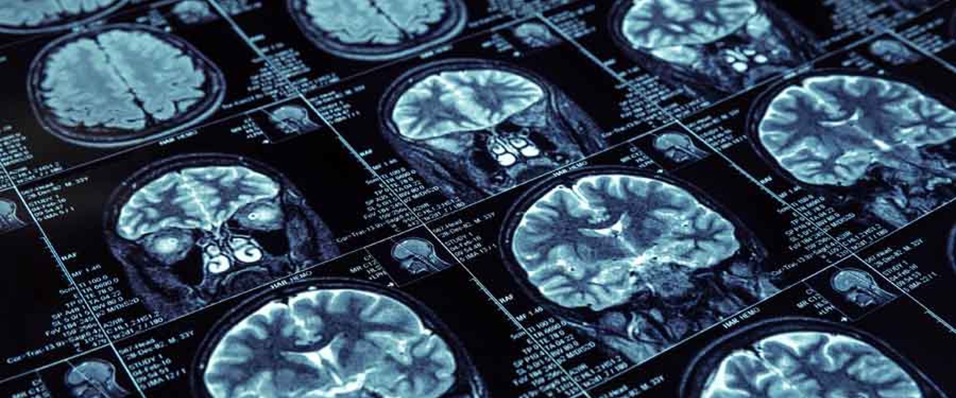 MRI brain scan