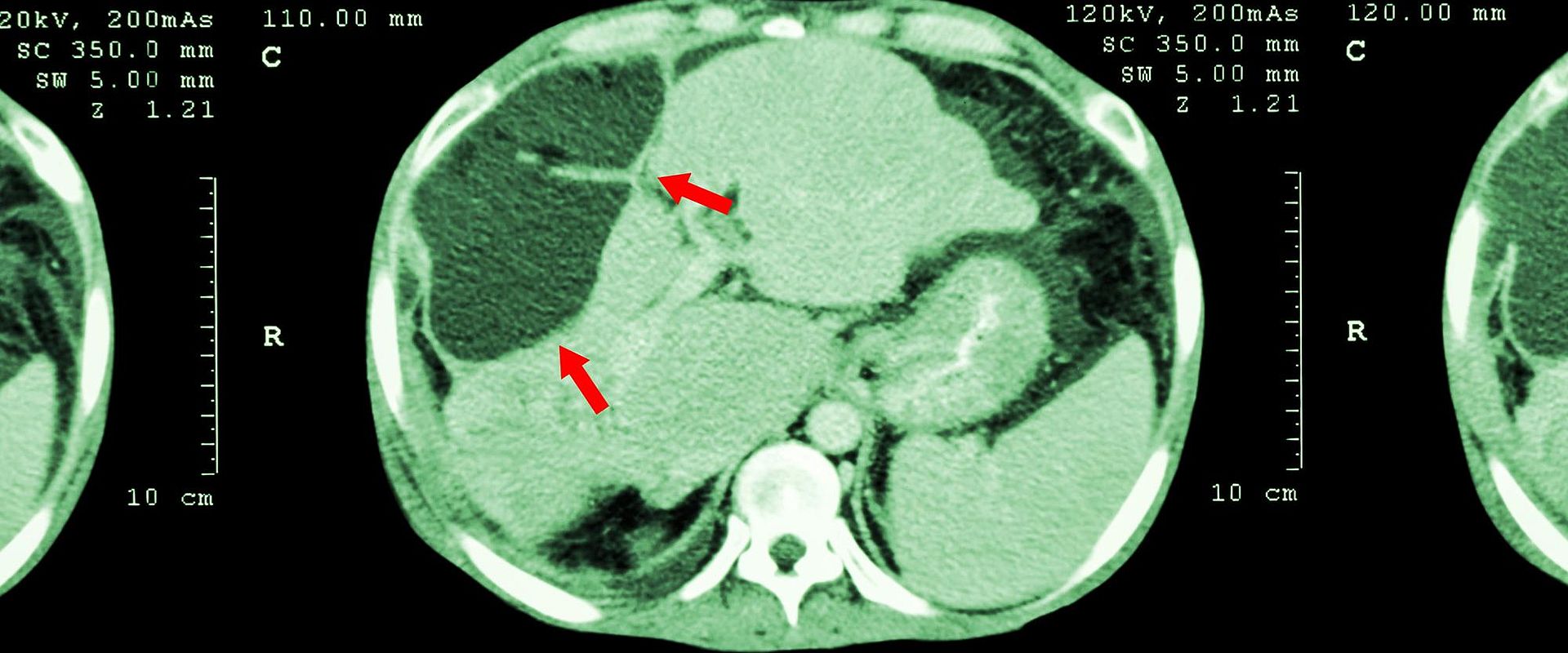 IStock 480196144 Abnormal mass at liver web