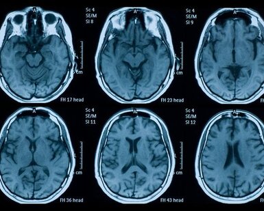 Image showing MRI scan of the brain