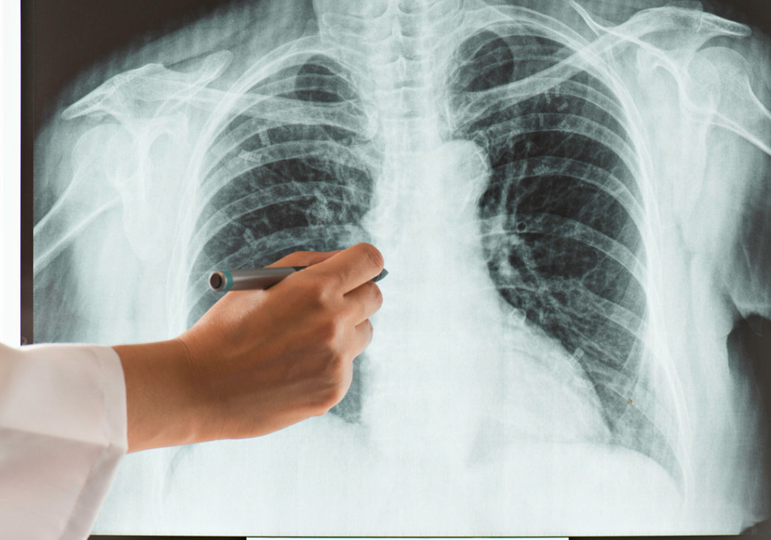 Image showing a chest x-ray